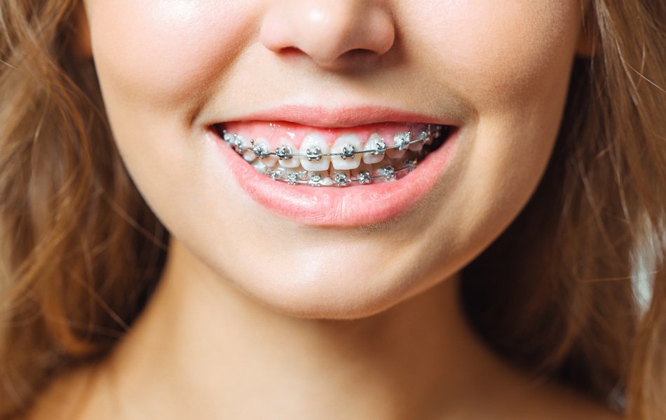 Smile female showing dental braces