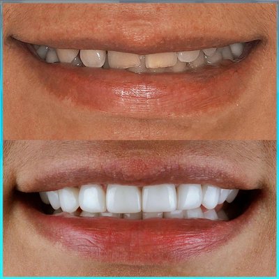 Brand new smile design. Call us now to schedule a…