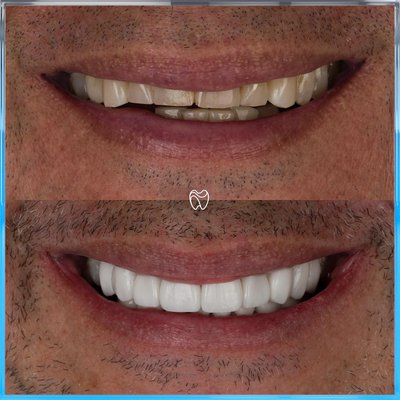 Did you know that veneers can be designed with di…